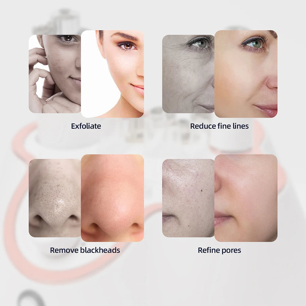 Foreverlily 3 in 1 Diamond Microdermabrasion Machine